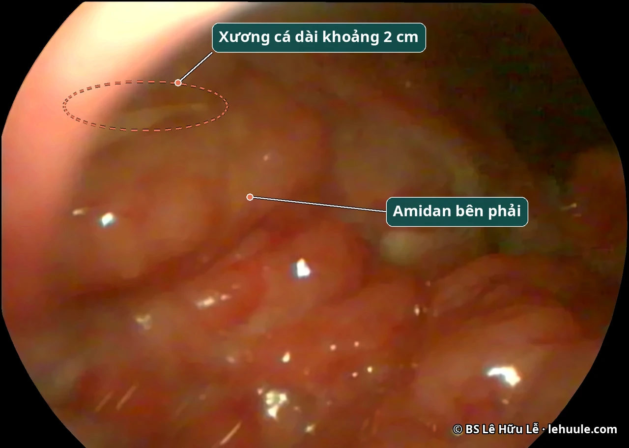 Ảnh nội soi: xương cá dài khoảng 2 cm cắm vào amidan bên phải