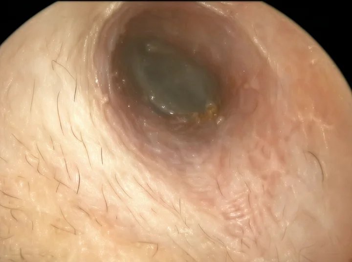 Nội soi màng nhĩ bình thường, không thủng